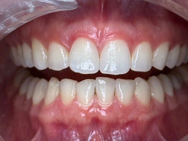 After Invisalign treatment at a Dentist in Cambridge, showcasing perfect teeth alignment