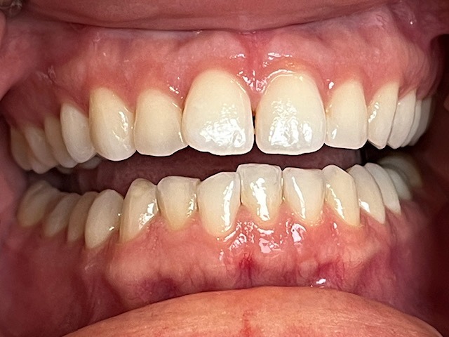 Before Invisalign treatment at a Dentist in Cambridge