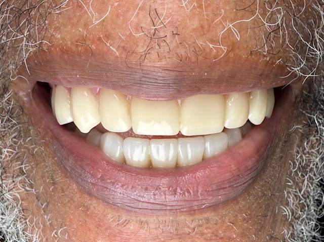 After Upper Full Denture + Lower Hybrid denture treatment at a Dentist in Cambridge, showcasing a restored smile