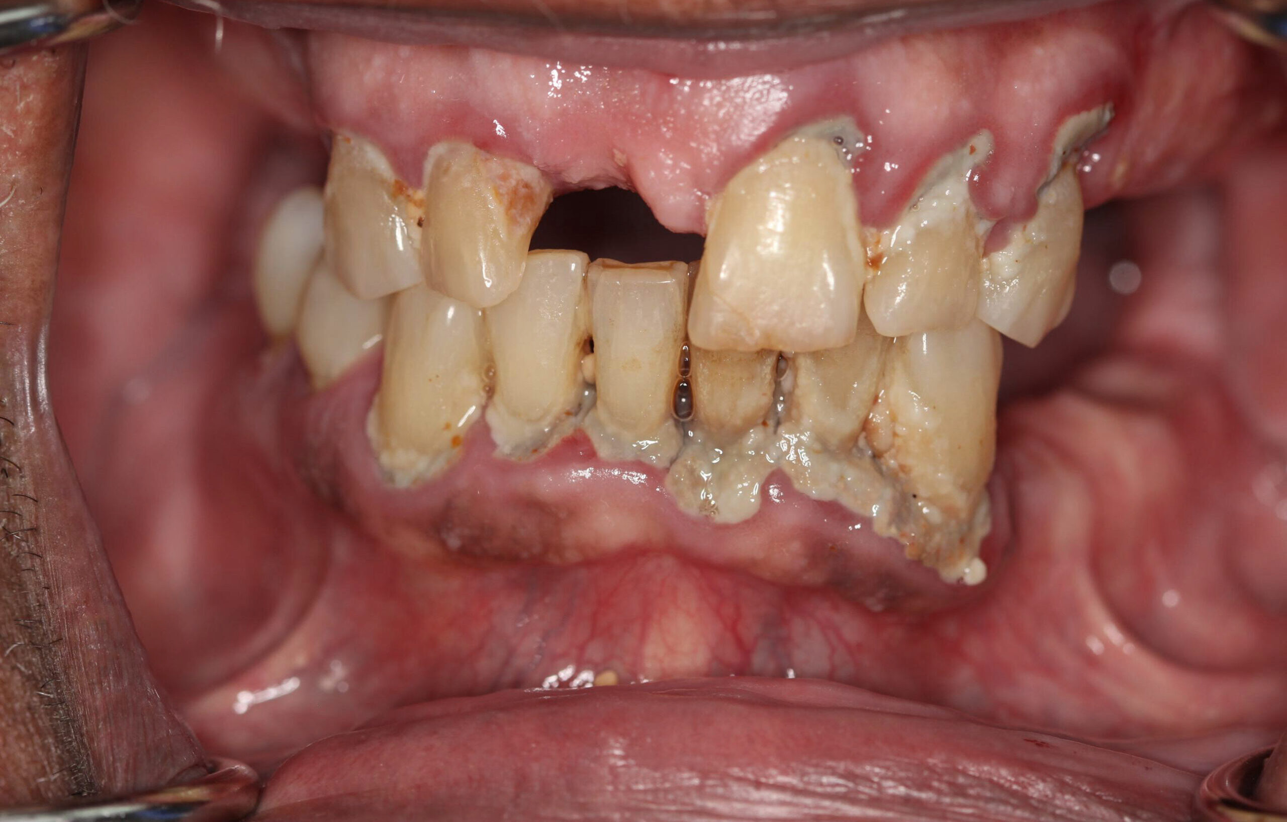 Before Upper Full Denture + Lower Hybrid denture treatment at a Dentist in Cambridge