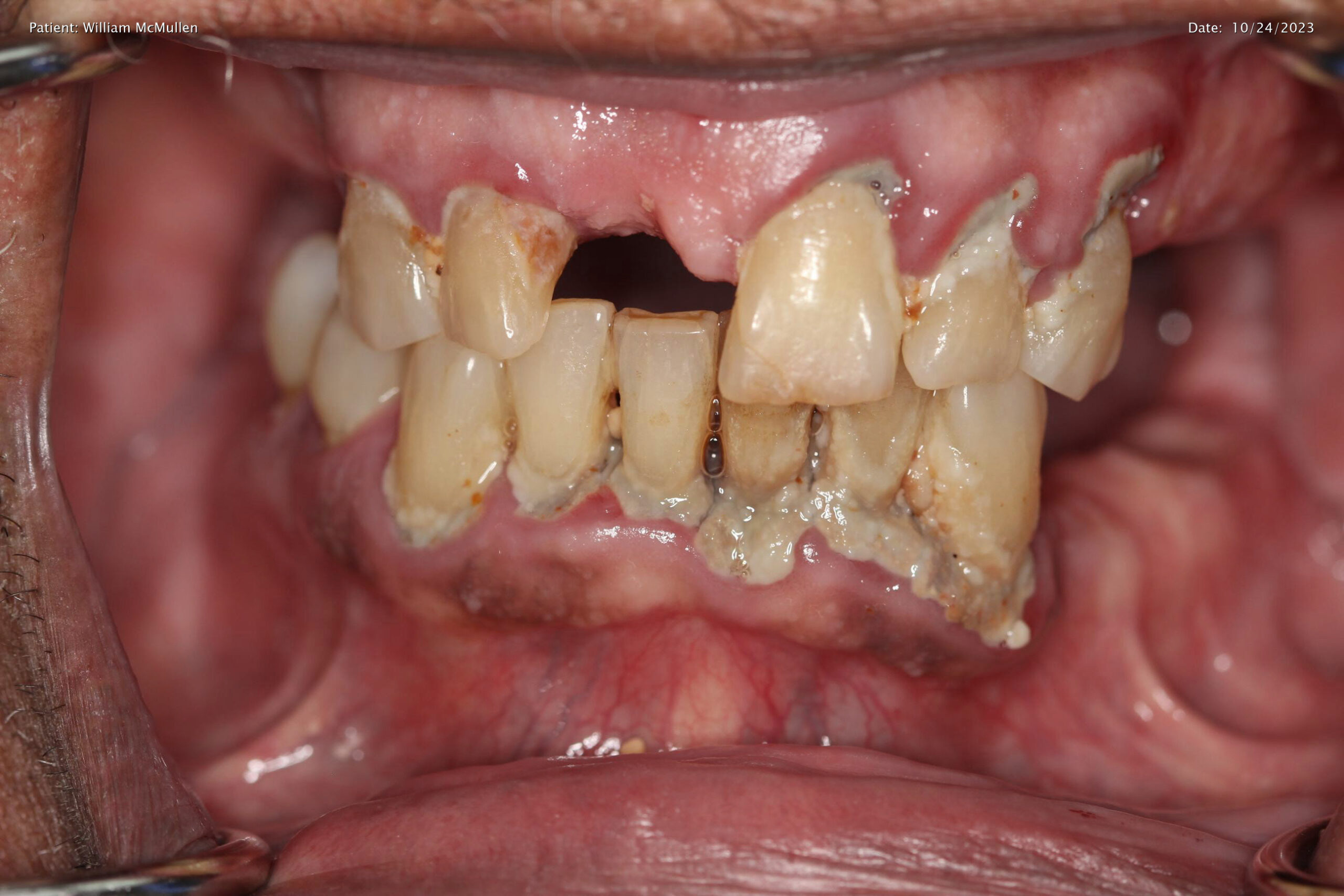 Before Upper Full Denture + Lower Hybrid denture treatment at a Dentist in Cambridge
